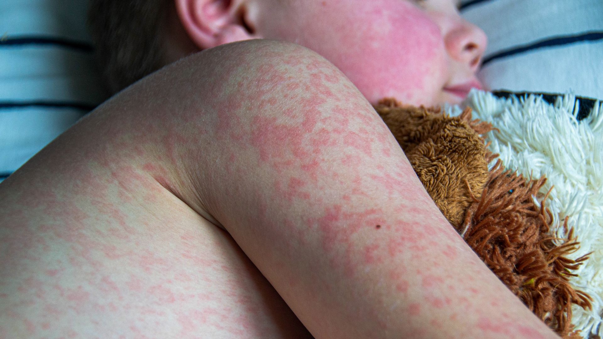 Measles cases worldwide almost double in a year - as England faces measles 'emergency'...