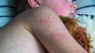 Measles rash on the body of the child. Allergy. Pic: iStock