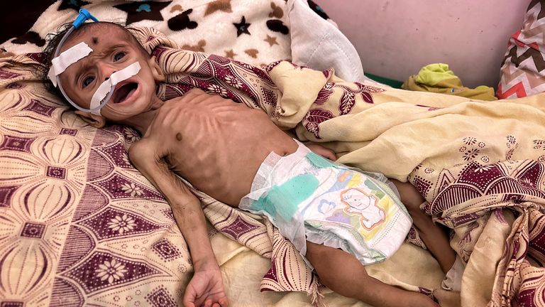 A baby lies in a Yemen hospital