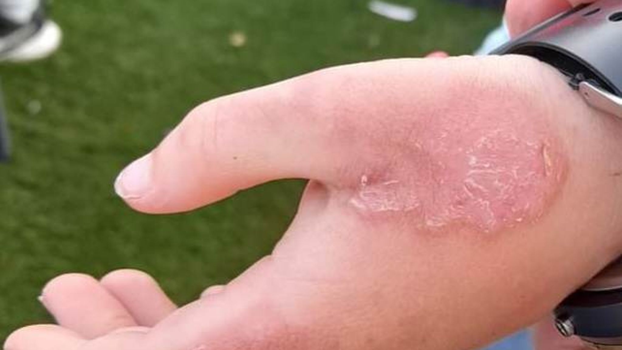 Boy, 8, 'scarred for life' after toxic giant hogweed plant causes ...