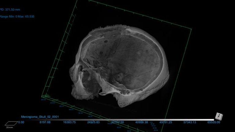 The skulls were examined using microscopic analysis and CT scanning. Pic: Tondini, Isidro, Camaros, 2024.