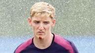 The cut face of Gordon after his fall from a bike. Pic: Rex Features