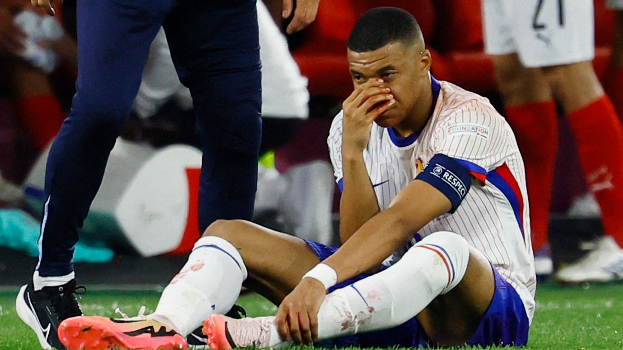 Euro 2024 France Captain Kylian Mbappe Suffers Broken Nose During Euro 2024 France Captain Kylian Mbappe Suffers Broken Nose During