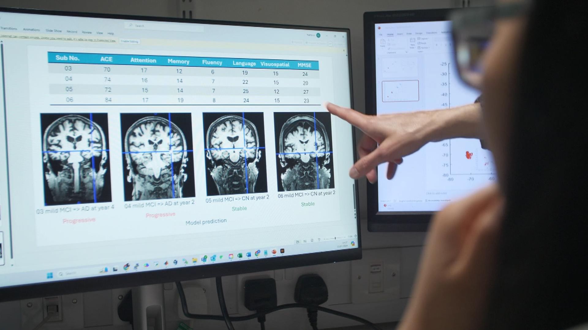 New AI tool could be game-changer in battle against Alzheimer's 