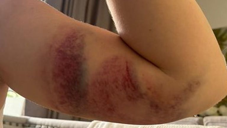 Ms Towey suffered bruising in an alleged assault. Pic: Detained in Dubai