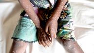 A suspected case of Mpox from 2022. File pic: AP