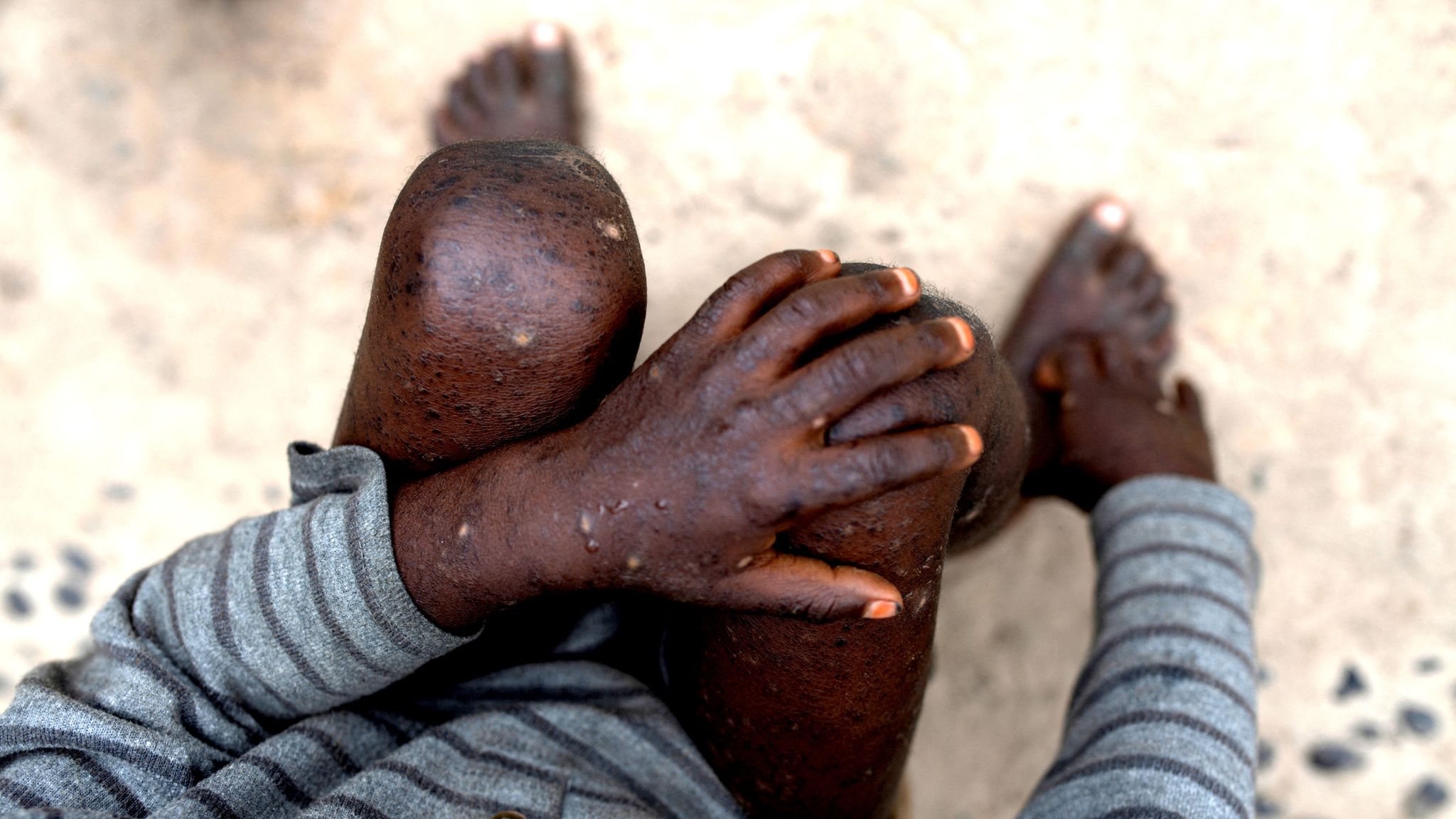 Man who contracted mpox describes 'horrendous' symptoms - as deadlier ...