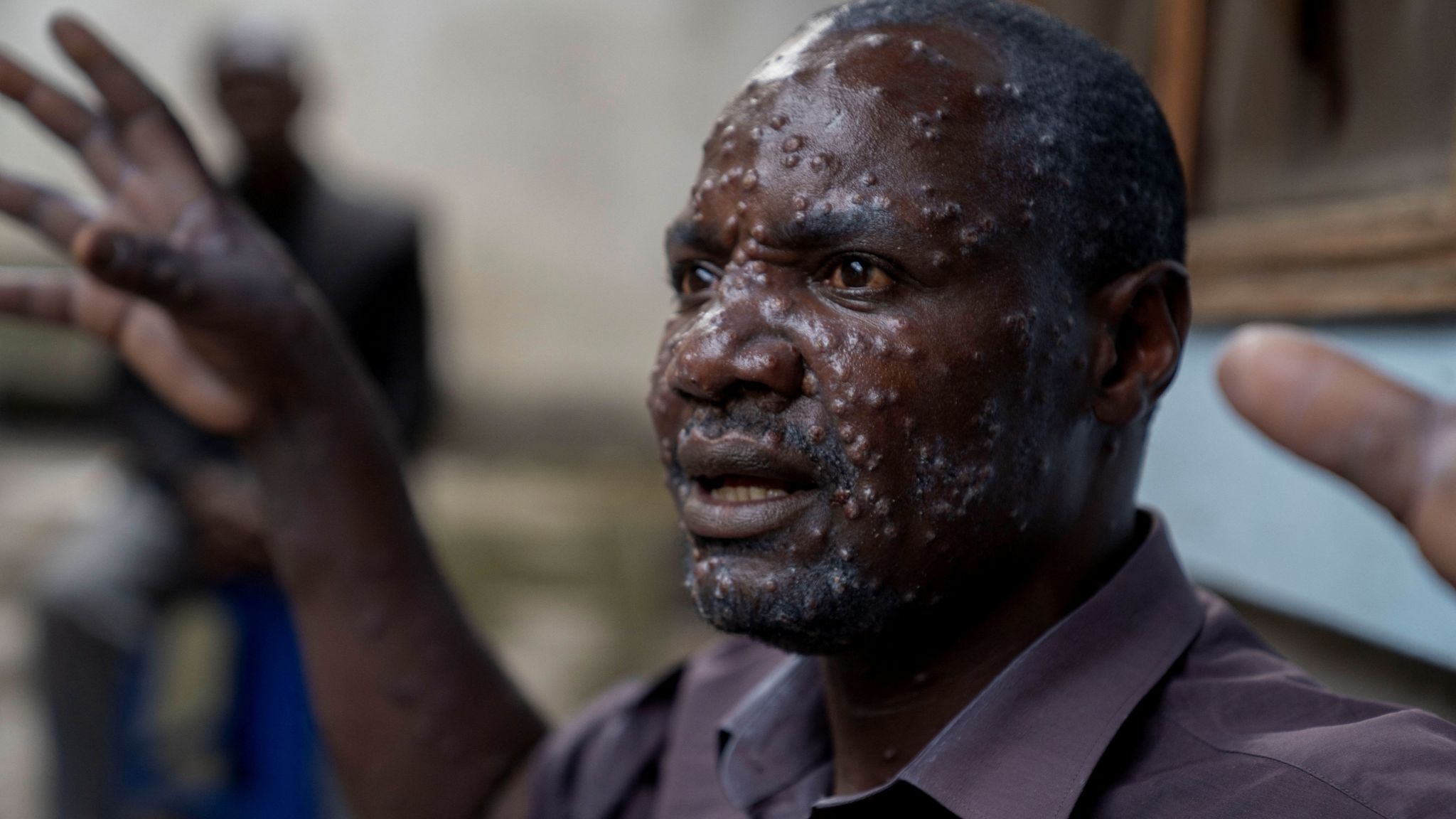 Questo è l'Inizio della Fine - Pagina 19 Skynews-mpox-congo_6655601