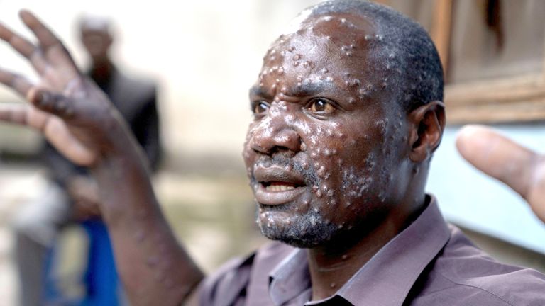 A man in the Democratic Republic of Congo has lesions on his face after contracting mpox in the latest outbreak. Pic: Reuters