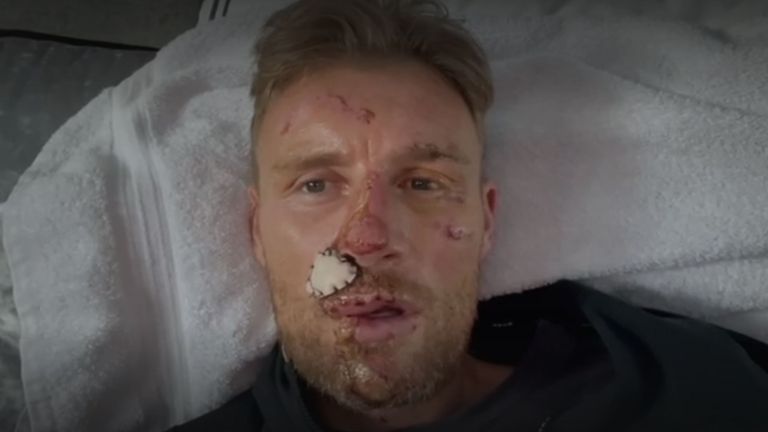 Flintoff shows the extent of his injuries shortly after the crash. Pic: BBC