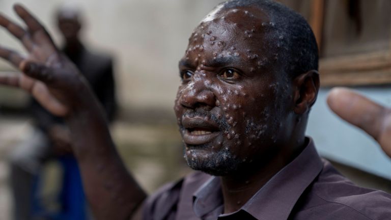 A man in the Democratic Republic of Congo has lesions on his face after contracting mpox in the latest outbreak. Pic: Reuters