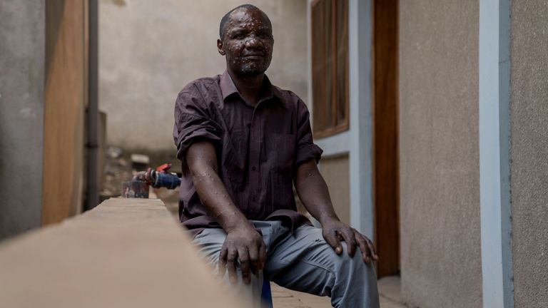 A man in the DRC infected with mpox. Pic: Reuters