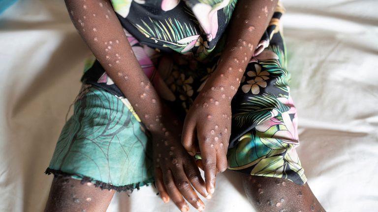 A suspected case of mpox. File pic: Reuters