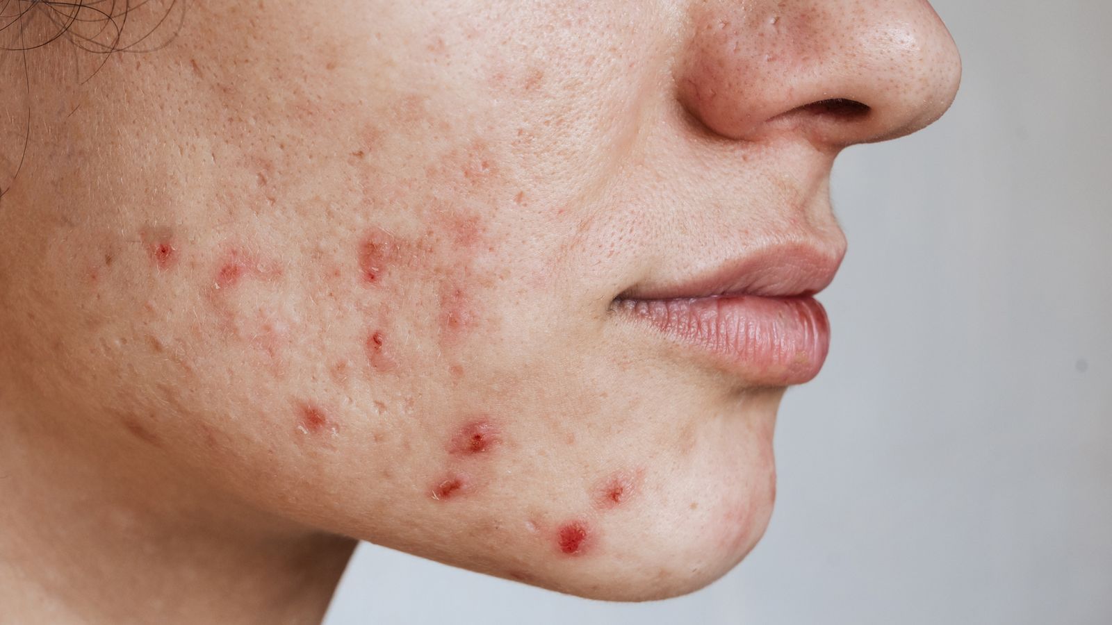 Germany's teenagers and young people have worst acne, with UK in the top 10, study finds