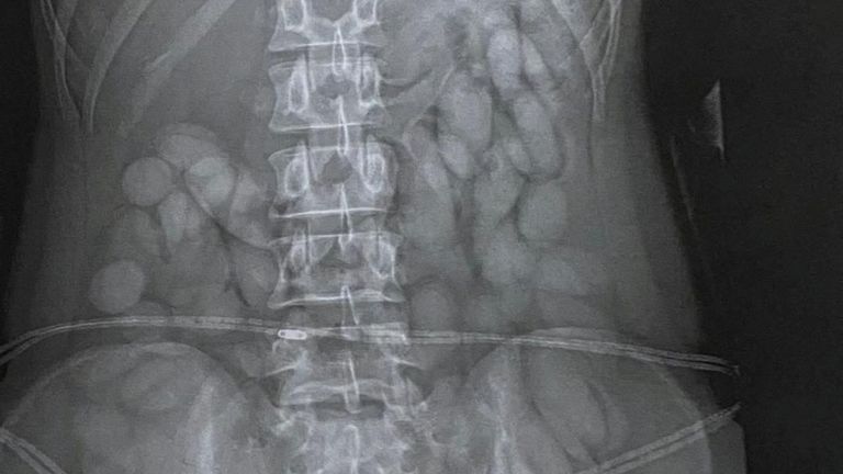 Police alleged the packages the woman seemingly swallowed contained cocaine. Pic: Reuters