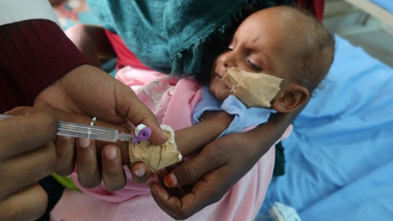 A child, suffering from malnutrition, is treated at Port Sudan Paediatric Centre, during a visit by WHO Director-General Tedros Adhanom Ghebreyesus to the country, in Sudan, September 7, 2024. REUTERS/El Tayeb Siddig