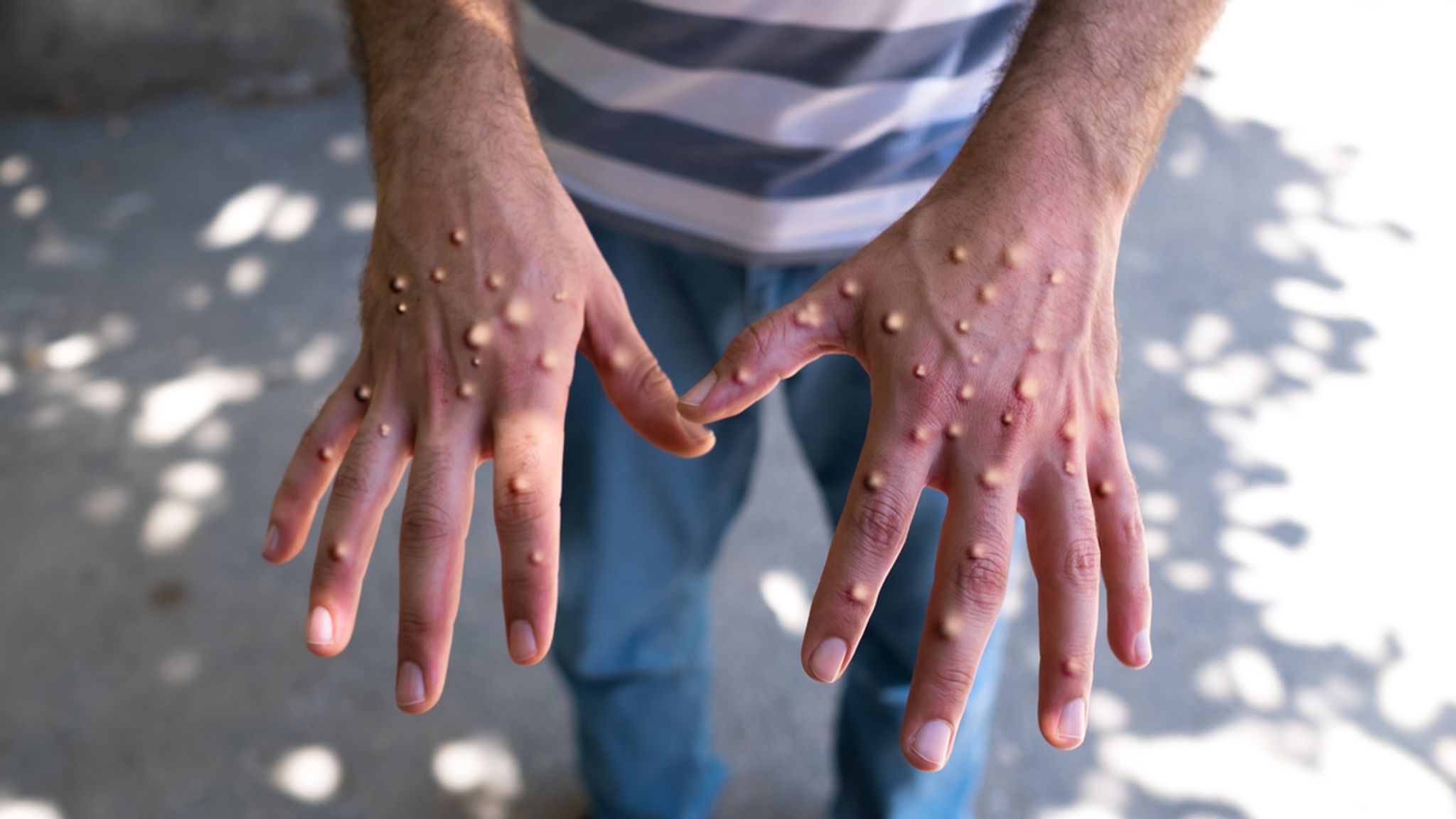 First Case Of New Mpox Strain Recorded In US, California Health ...