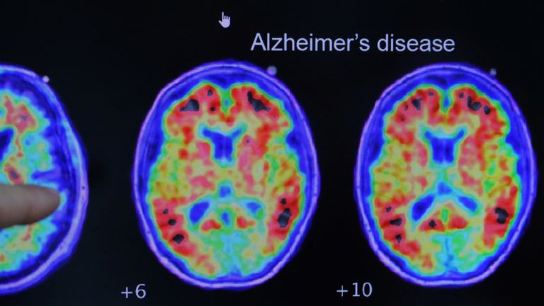 A brain scan of someone with Alzheimer's disease.
Pic: Reuters