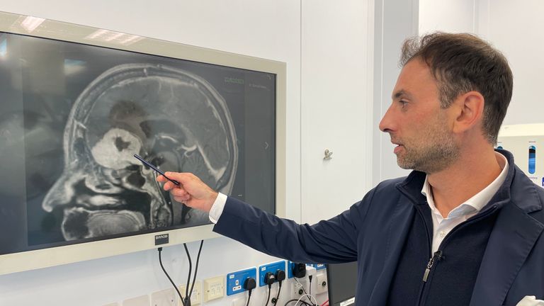 Consultant neurosurgeon Anastasios Giamouriadis of NHS Grampian has adapted an existing technique of keyhole surgery to remove brain tumours through eyebrows. Pic: PA 