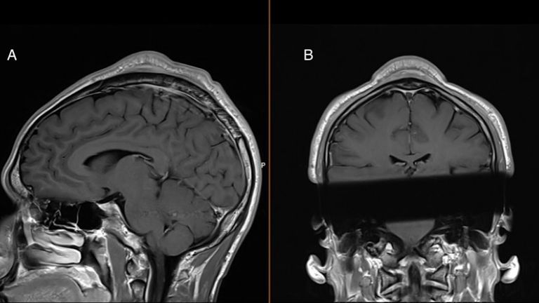 An MRI scan shows the 'breakdance bulge' on the man's head. Pic: BMJ Case Reports/PA