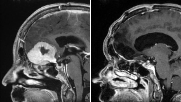 A scan of Doreen Adams with her brain tumour shown in white (left) and after it was removed through her eyebrow (right). Pic: NHS Grampian