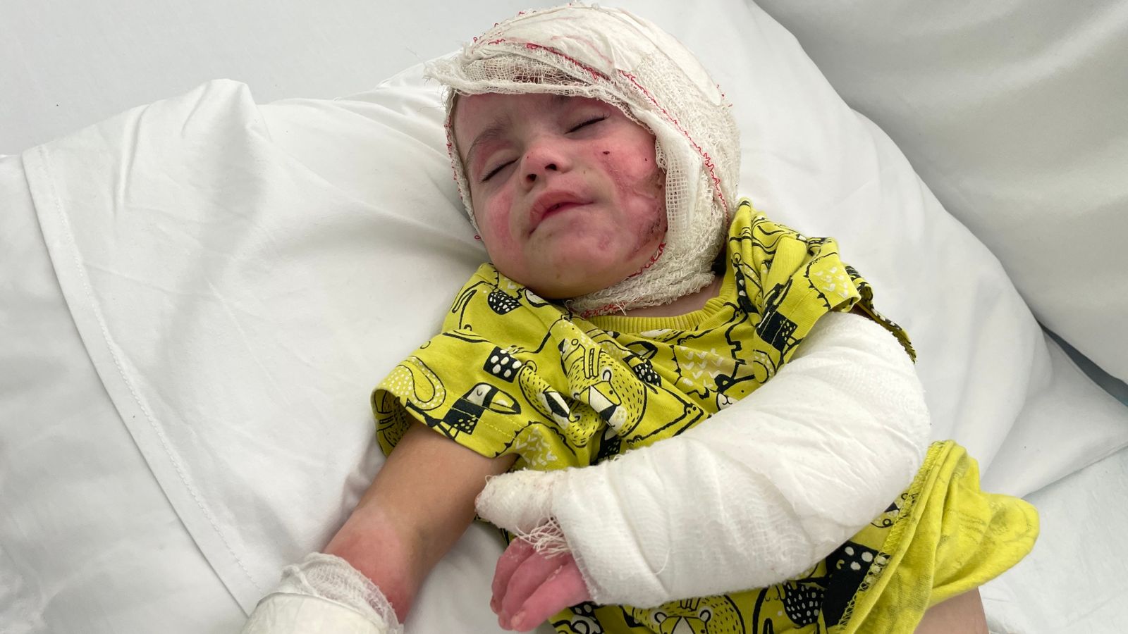 ‘She couldn’t move her mouth’: Baby suffers burns on more than half her body in Israeli airstrike | World News