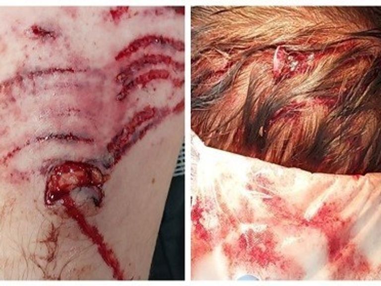 Some of the injuries caused by the American bulldog attack. Pic: South Yorkshire Police