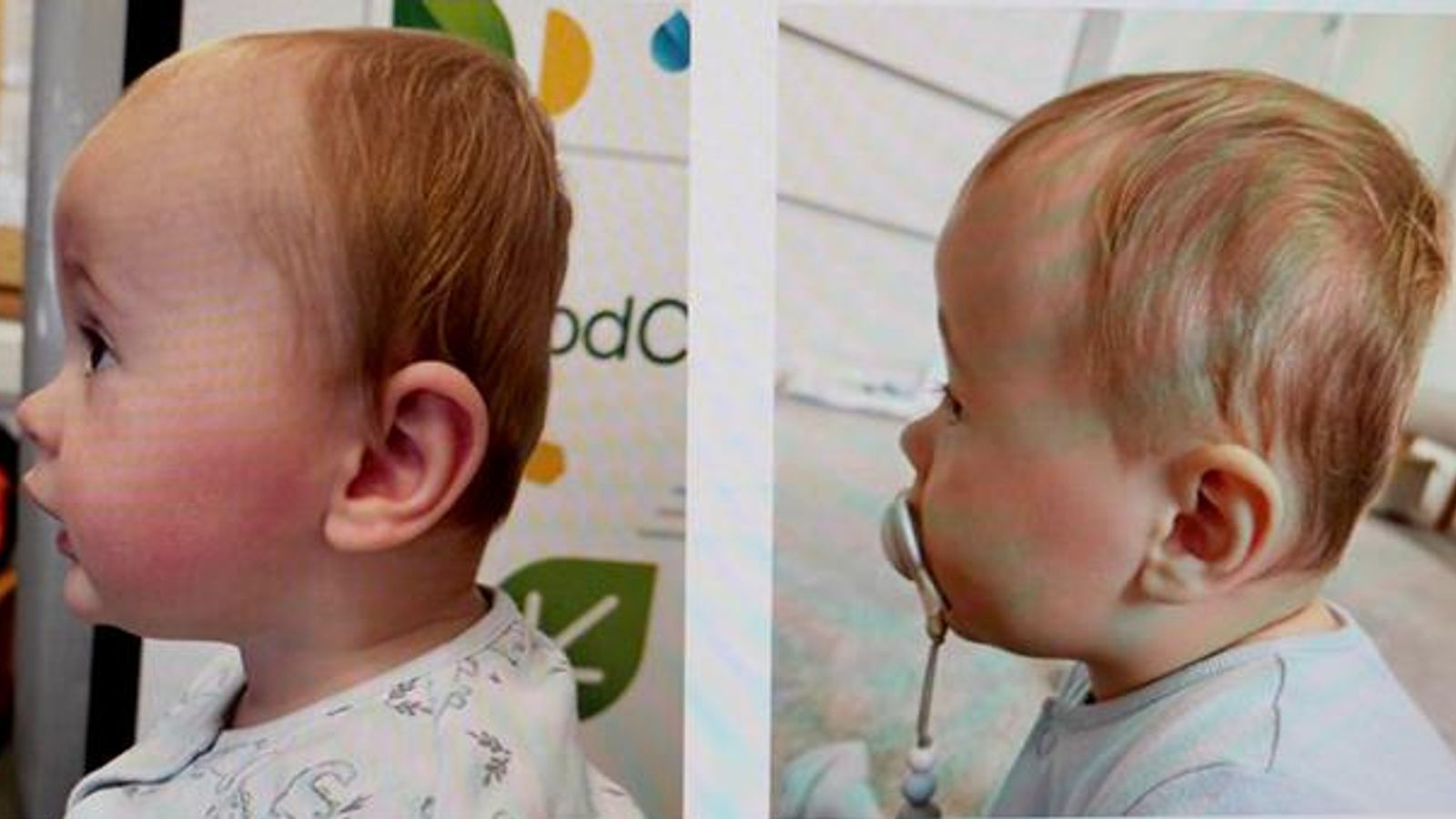 Calls for more research into flat head syndrome in babies and whether helmet therapy works