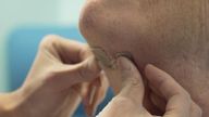 Surgeons make a small incision under the chin and place a chip on a nerve that controls a muscle in the tongue