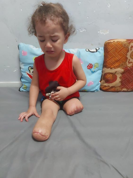 Both Rafah's legs had to be amputated