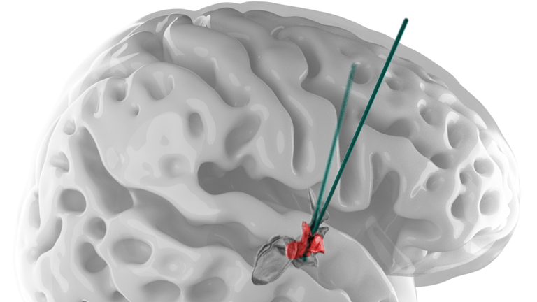 A visual representation of the deep brain stimulation of the lateral hypothalamus. Pic: NeuroRestore/EPFL 2024