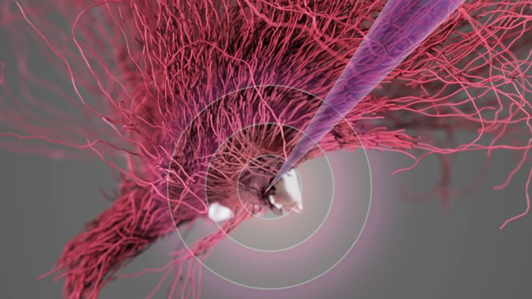 A visual representation of the deep brain stimulation of the lateral hypothalamus. Pic: NeuroRestore/EPFL 2024