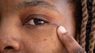 A small scar at the corner of Ruvimbo Kaviya's eye after she became the first person in the UK to receive groundbreaking surgery to remove a tumour through her eye socket at Leeds General Infirmary. Picture date: Thursday January 16, 2025.