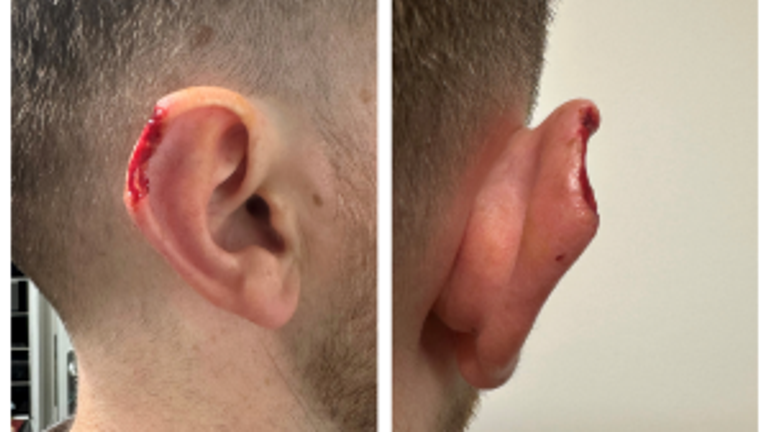 PC James Marsden was told his ear would be permanently disfigured. Pic: North Wales Police