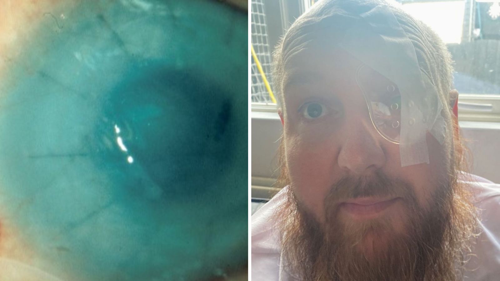 Battery acid attack victim reveals how donated placenta treatment saved his eye