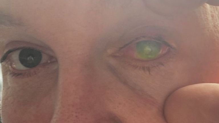 Paul's eyes after the first amnion graft