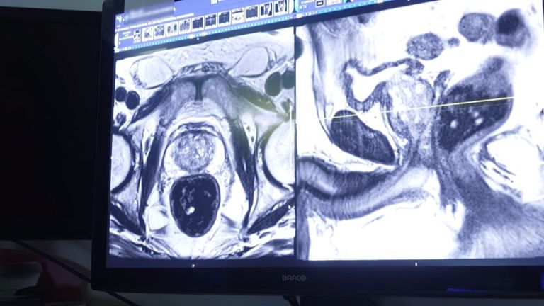 An example of a prostate tumour seen on a MRI scan