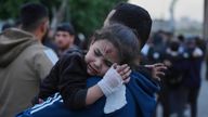 A young Palestinian girl who was injured in an Israeli airstrike, is brought for a treatment at the Baptist Hospital in Gaza City, on Thursday, April 3, 2025. (AP Photo/Jehad Alshrafi)