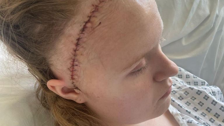 Ellie Morris-Davies after surgery. Pic: Alder Hey Hospital/PA
