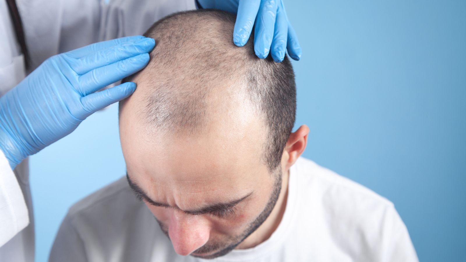 Money blog: ‘I’m a hair surgeon – here’s how it works, what it costs and the celebrity with best transplant’ | Money News
