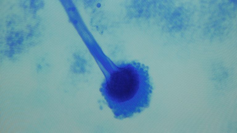 A sample of Aspergillus fumigatus, the first fungus diagnosed in the fungal meningitis outbreak sweeping the United States, in Nashville, Tennessee on October 19, 2012. The outbreak, which was first diagnosed in the Vanderbilt Clinical Microbiology Lab for patient care has infected 257 people to date nationwide and 20 have died. Pic: Reuters