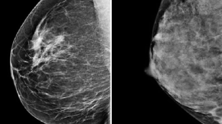 Mammogram images of healthy breasts showing fatty/least dense (left) and dense (right) Pic: Cambridge University Hospitals NHS Foundation Trust