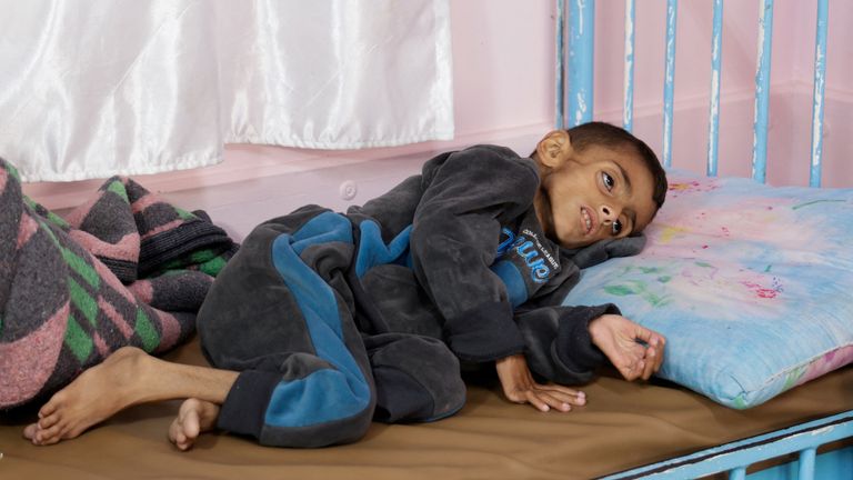 Palestinian boy Osama Al-Reqep, 5, lies on a bed at Nasser Hospital, in Khan Younis, in the southern Gaza Strip. Pic: Reuters