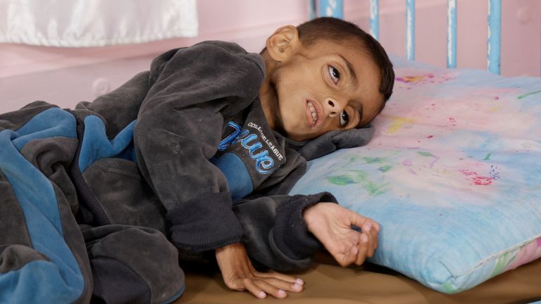 Palestinian boy Osama Al-Reqep, 5, lies on a bed at Nasser Hospital where he receives treatment, in Khan Younis, in the southern Gaza Strip, May 1, 2025. REUTERS/Hatem Khaled