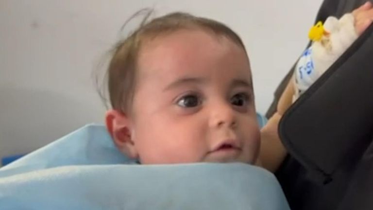 A baby brought into the burns unit at Nasser hospital 