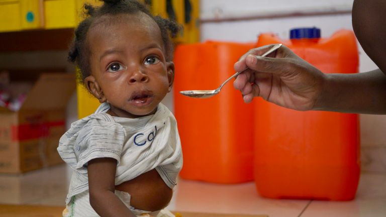 A malnourished child at the Fontaine Hospital.