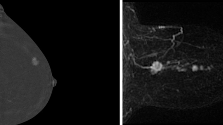 Breast scans using CEM (left) and AB-MRI (right) show tumours not seen on mammograms. Pic: Cambridge University Hospitals NHS Foundation Trust