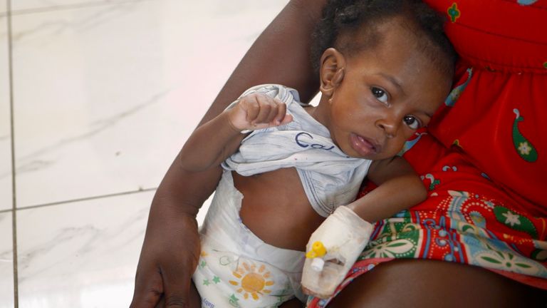 A malnourished child at the Fontaine Hospital.
