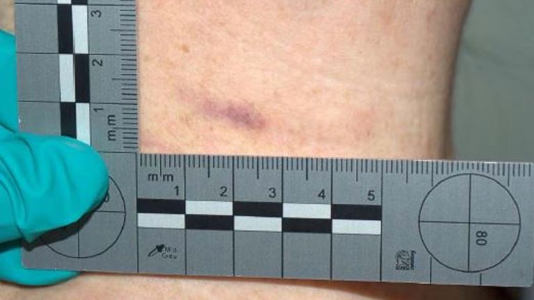 Kerry's neck injury. Pic: CPS