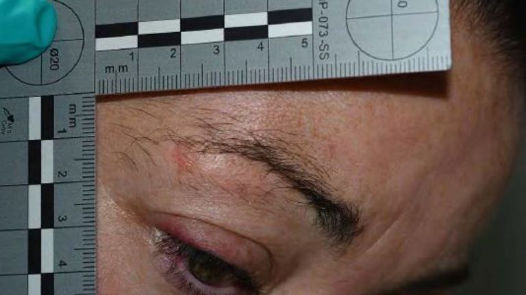 Injury to Kerry's eye. Pic: CPS
